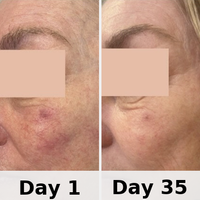 Red Light Therapy Mask