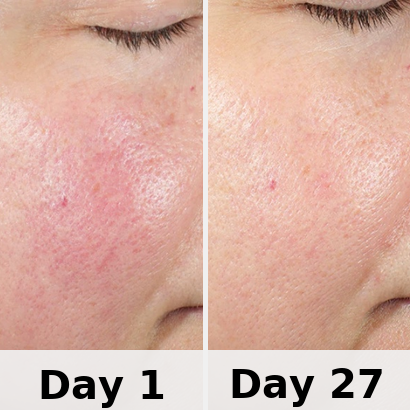Red Light Therapy Mask