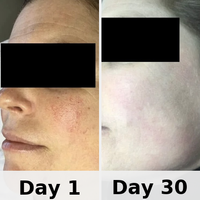 Red Light Therapy Mask