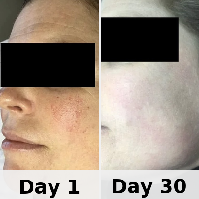 Red Light Therapy Mask