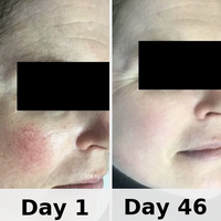 Red Light Therapy Mask